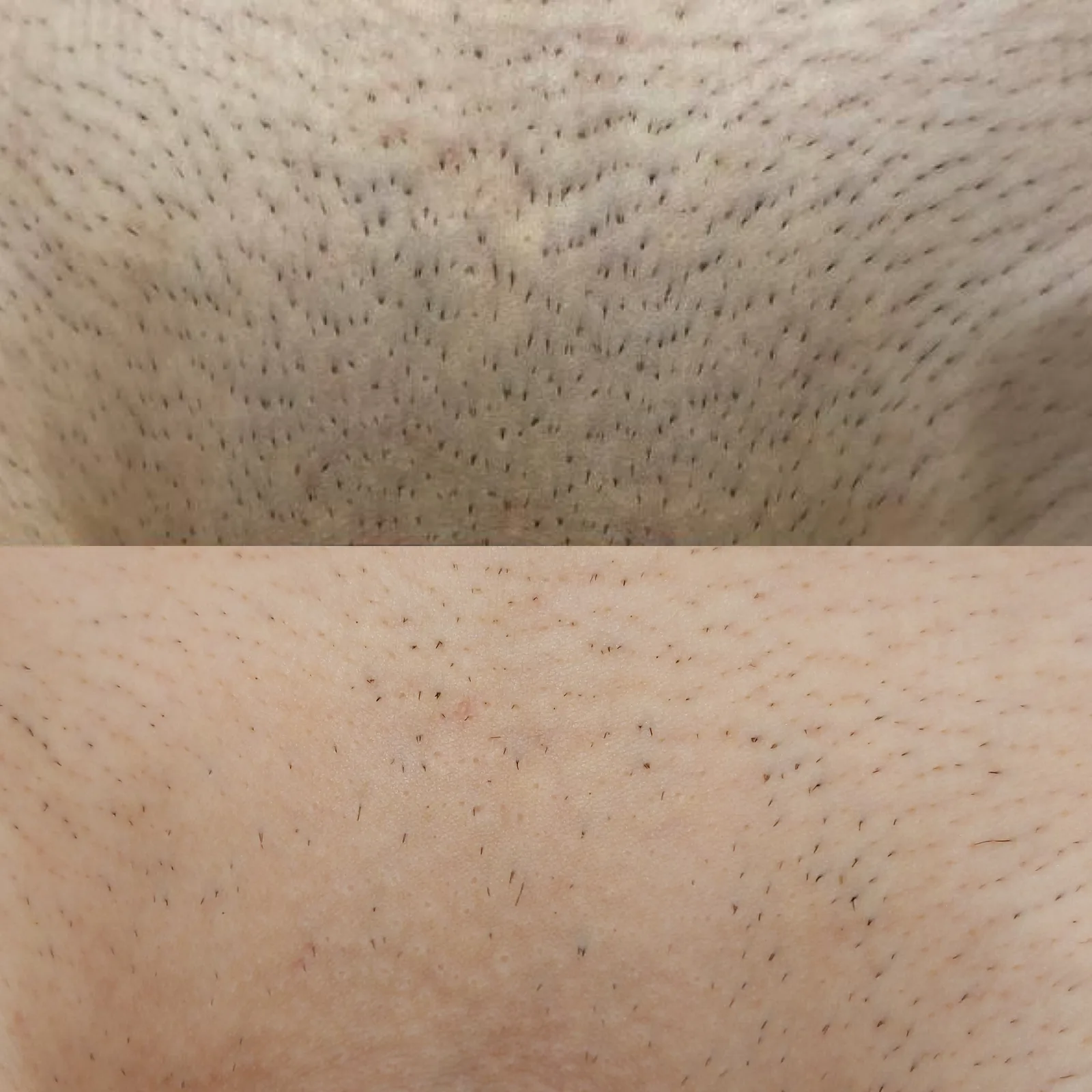 Before and after result 2 visits