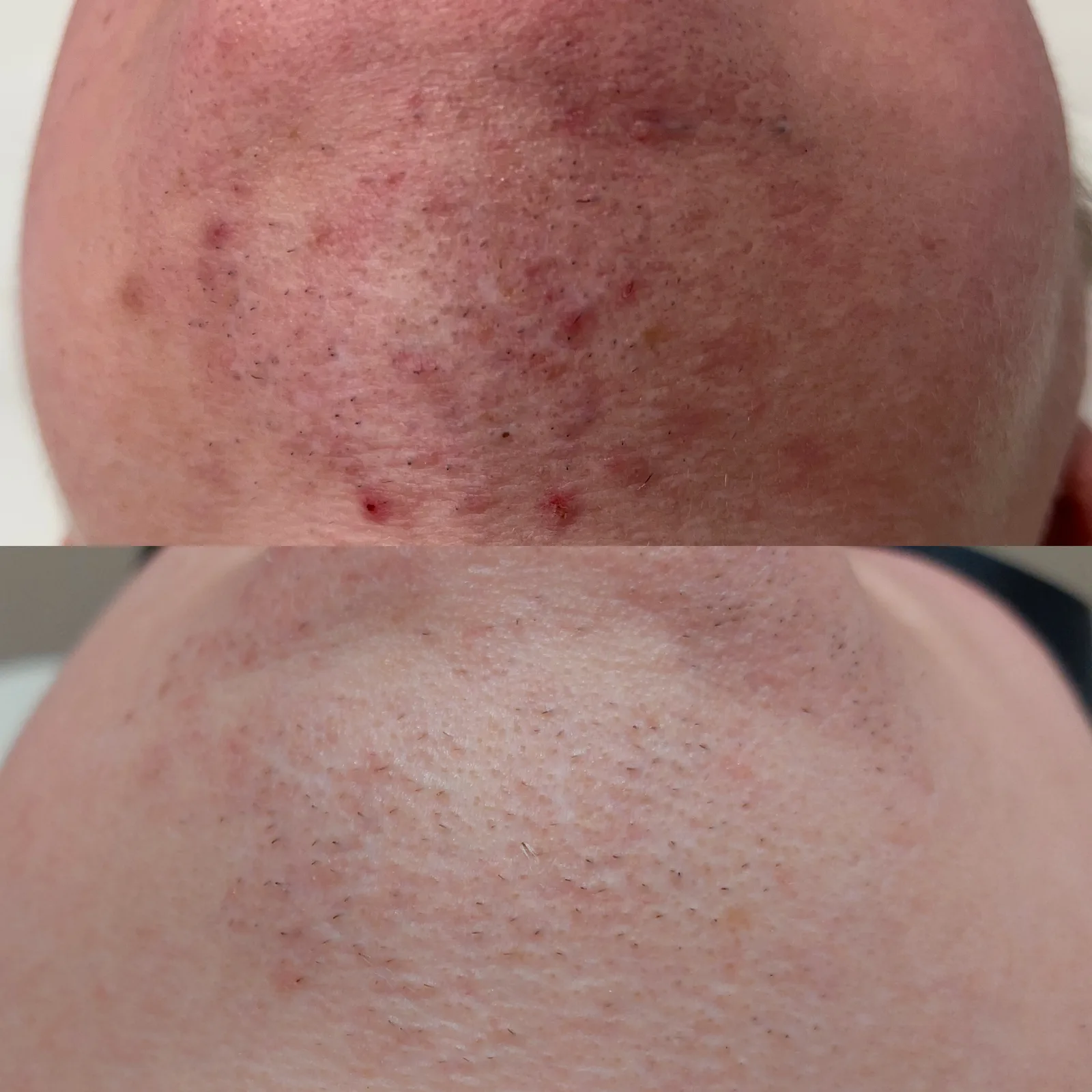 Before and after result 5 visits