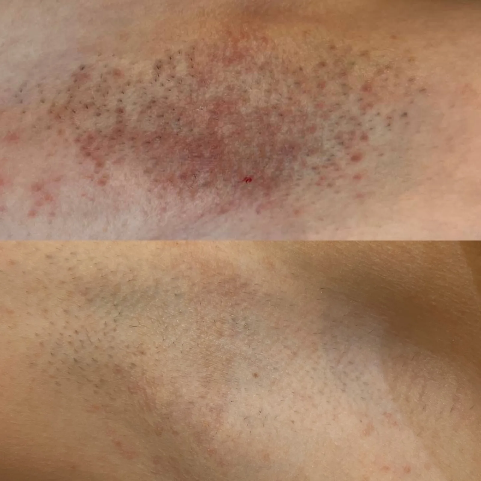 Before and after result 5 visits
