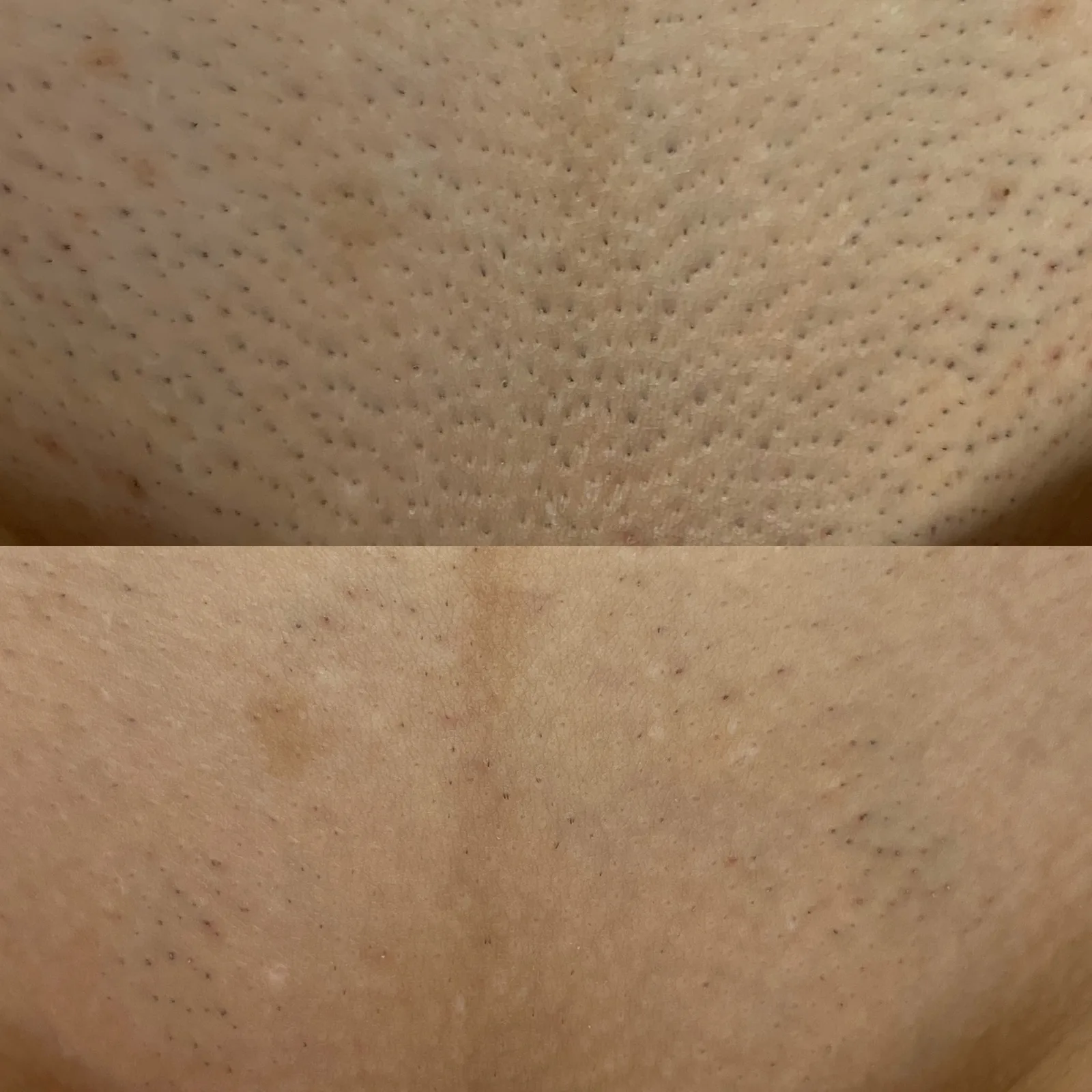 Before and after result 4 visits